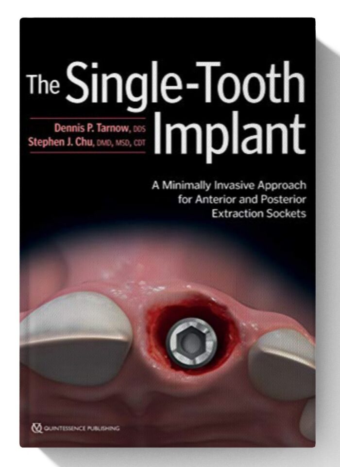 The Single-Tooth Implant: A Minimally Invasive Approach for Anterior and Posterior Extraction Sockets 1st Edition